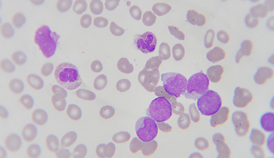 Befallene Blutzellen unter einem Mikroskop